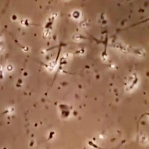 Infertilité masculine